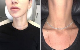 Bị ám ảnh với những vết ngấn trên cổ, cô nàng này đã quyết định tiêm botox và nhận được kết quả mĩ mãn