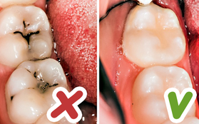 8 mẹo vặt hữu ích giúp bạn luôn nói không với bệnh sâu răng