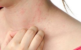Bệnh chàm với triệu chứng đỏ, mẩn ngứa trên da có thể do 6 nguyên nhân này gây ra nhưng lại bị bạn vô tình bỏ qua