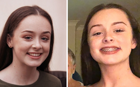 Cô gái 15 tuổi suýt chết vì bệnh nhiễm khuẩn, nguyên nhân được chẩn đoán là từ... niềng răng