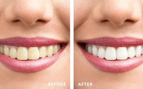 2 cách làm trắng răng cực nhanh, rẻ mà hiệu quả có ngay trong nhà nhưng không phải ai cũng biết cách