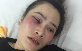 Đà Nẵng: Tranh nhau ăn trước đĩa bánh xèo, nam sinh viên đánh cô gái gãy răng cửa, phải nhập viện cấp cứu