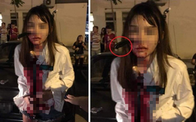 Malaysia: Bị tấn công khi đang bắt taxi, cô gái bình tĩnh đi báo công an với con dao cắm giữa mặt