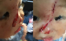 Trung Quốc: Em bé 1 tuổi đang chơi ngoài công viên thì bị flycam sà xuống chém trúng mặt