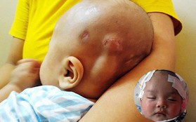 Tiếng khóc xé lòng của bé trai hơn 5 tháng tuổi mắc bệnh não úng thủy
