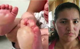 Mỹ: Tức giận vì bé 6 tháng tuổi quấy khóc, bảo mẫu nhẫn tâm nhúng 2 bàn chân bé vào chảo dầu sôi
