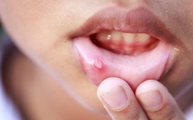 7 triệu chứng thường gặp của bệnh ung thư miệng mà nhiều người hay nhầm lẫn