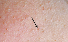 Tất tần tật những điều cần biết về chứng viêm nang lông thường hay mắc phải trong mùa hè