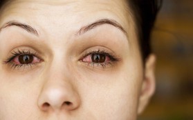 Vệt đỏ trong mắt có thể ngầm báo hiệu một số vấn đề sức khỏe nghiêm trọng