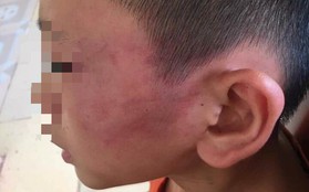 Nghệ An: Nghi án bé trai 12 tuổi bị mẹ kế đánh thương tích đầy mình phải nhập viện