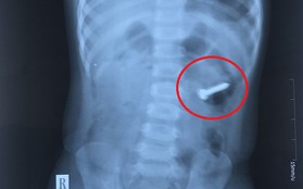 Nghệ An: Phẫu thuật lấy đinh ốc dài 3cm trong lồng ruột bé 2 tuổi