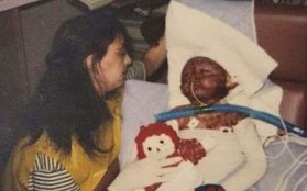 2 tuổi đã bị bỏng toàn thân vì máy giặt phát nổ, hơn 20 năm sau ai cũng bất ngờ khi nhìn thấy dáng vẻ của người phụ nữ ấy