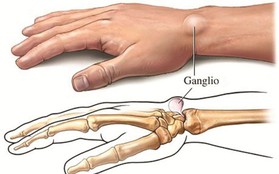 6 dấu hiệu cảnh báo sớm bệnh ung thư xương mà bạn không nên chủ quan bỏ qua