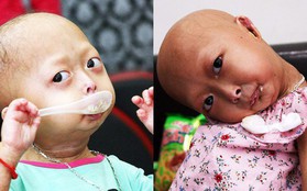 Mẹ của 2 bé gái bị đầu, cổ vẹo lệch ở Tuyên Quang: Giá như con khỏi bệnh, dù đánh đổi gì tôi cũng cam lòng