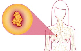 Đây là 4 căn bệnh ung thư thường gặp ở nữ giới mà bạn nên tìm hiểu ngay từ bây giờ