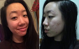 Thoa dầu dừa lên da trong 1 tuần để chữa sẹo mụn, cô nàng này đã nhận được kết quả đáng thất vọng