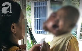 Bé trai 6 tuổi ở Tây Ninh mang khối u ác tính to khủng khiếp trên mặt vì cha dẫn đi đắp lá thuốc trôi nổi