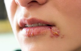 Các triệu chứng Herpes ở phụ nữ không nên bỏ qua