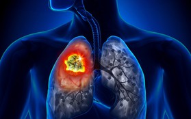 Ung thư phổi: Căn bệnh có thể mắc phải bất cứ lúc nào và nguyên nhân lại đến từ những thứ thân thuộc xung quanh bạn