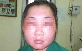 Dùng "mỹ phẩm dân tộc” mong da đẹp "lột xác", cô gái 19 tuổi bị biến dạng cả mặt, mắt híp lại và sưng vù kinh dị