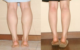 4 thói quen tai hại khiến bắp chân ngày càng phình to mất kiểm soát