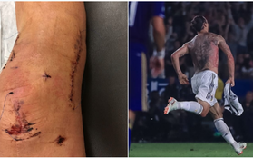Ibrahimovic lần đầu tiết lộ hình ảnh chấn thương đáng sợ ở MU