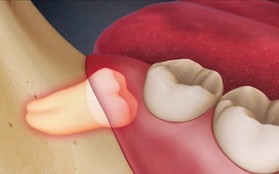 Ai cũng phát điên vì răng khôn và bạn nhất định phải biết những điều này về chúng