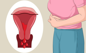 Lạc nội mạc tử cung và 6 dấu hiệu điển hình của căn bệnh này mà con gái không nên chủ quan bỏ qua