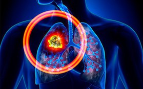 Ngăn ngừa ung thư phổi từ sớm nhờ duy trì 5 thói quen sau đây mỗi ngày