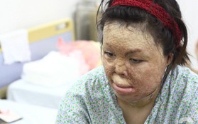 Sau 1 năm và hàng chục cuộc phẫu thuật, người vợ Hà Nội bị chồng thiêu hôm mùng 2 Tết, chỉ có 1% cơ hội sống sót đã "hồi sinh"