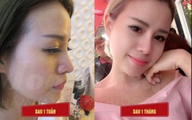 Sau S-line, kỹ thuật nâng mũi dáng S-Mode lại đang “dậy sóng”