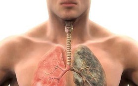 8 dấu hiệu sớm và triệu chứng ung thư phổi
