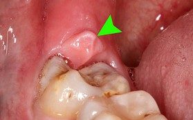 Không muốn bị sâu răng từ sớm thì nên hình thành dần 7 thói quen lành mạnh sau