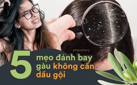 Nếu trị gàu không hiệu quả với dầu gội hãy thử ngay với 5 mẹo này