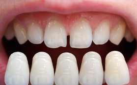 5 triệu chứng bất thường ở răng miệng cảnh báo nhiều vấn đề nguy hại mà bạn không nên chủ quan bỏ qua