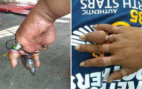 Người đàn ông ở Thái đeo nhiều nhẫn tới nỗi suýt bị hoại tử, thối rữa hết các ngón tay