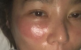Mỹ nữ xứ Hàn bị bỏng rát mặt chỉ vì một lần đắp mặt nạ qua đêm: Lời cảnh báo thói quen làm đẹp chị em cần chấn chỉnh!