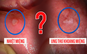 4 dấu hiệu loét miệng ngầm cảnh báo bệnh ung thư đang âm thầm phát triển