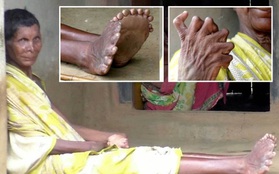 Có đến 12 ngón tay, 19 ngón chân do dị tật bẩm sinh, người phụ nữ phải trốn chui trốn nhủi trong nhà vì bị đồn là phù thủy