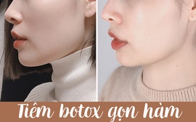 Tôi đi tiêm botox gọn hàm: 1 lần botox Âu Mỹ, 1 lần botox Hàn, mặt chỉ thay đổi "sương sương" chứ không lột xác được như người ta