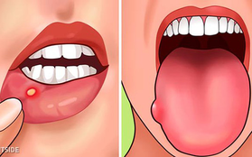 Cẩn thận với những biểu hiện bất thường trên lưỡi đang ngầm cảnh báo sức khỏe của bạn có vấn đề