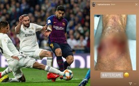 Nhà vô địch World Cup 2018 hé lộ chấn thương rợn tóc gáy sau thảm bại 0-3 của Real Madrid