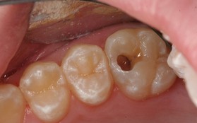 Răng có lỗ sâu to mà để lâu sẽ dẫn đến những biến chứng gì?