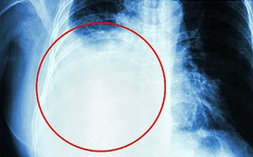 Những triệu chứng cho thấy ung thư vú di căn sang phổi và các cách để phòng tránh