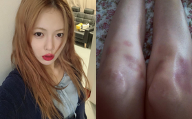 Hyuna khoe ảnh chụp đầu gối đầy những vết thâm tím, netizen lại được dịp suy diễn đủ điều