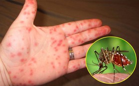 Chuyên gia cảnh báo: Cẩn trọng bệnh sốt xuất huyết đang có xu hướng tăng mạnh