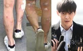 Giữa scandal ma tuý đá, đôi chân lở loét, chi chít mụn phồng rộp của Yoochun trở thành tiêu điểm nóng trên Weibo