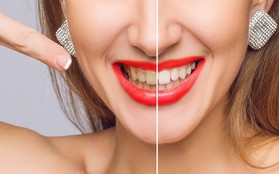 Sửa ngay những thói xấu khiến hàm răng của bạn ngày càng ố vàng, xỉn màu