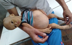 Sự sống mong manh của bé trai 1 tuổi, chỉ nặng 6kg, bụng phình to như cái trống mà mẹ nghèo không tiền chữa trị
