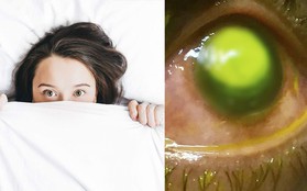 Đeo thứ này đi ngủ sẽ khiến mắt bạn dần bị ăn mòn giác mạc, thậm chí còn gây mù lòa